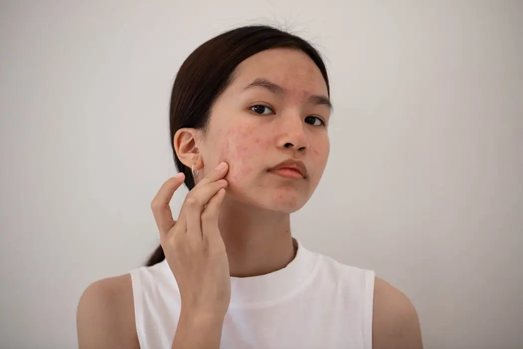 Acne treatment