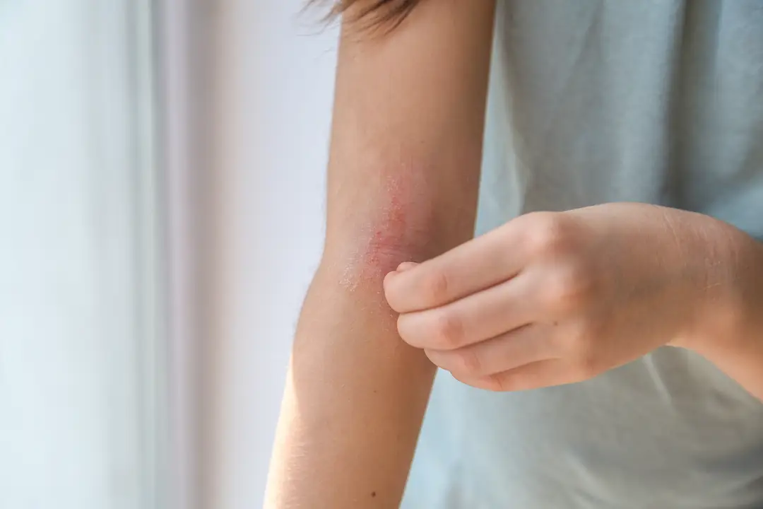 Eczema