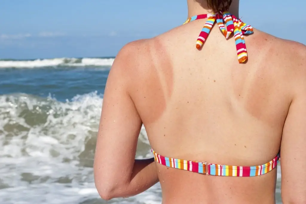 treat sunburn